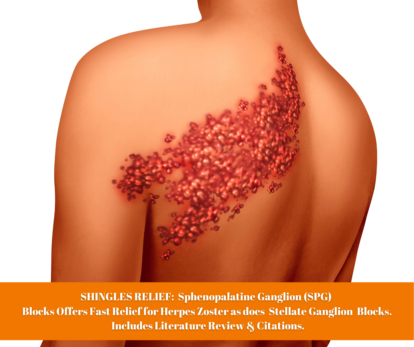 SHINGLES RELIEF:  Sphenopalatine Ganglion (SPG)  Blocks Offers Fast Relief for Herpes Zoster as does  Stellate Ganglion Blocks.  Includes Literature Review & Citations.
